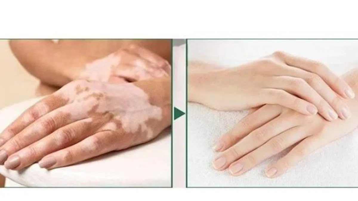 Dünyadaki birçok vitiligo hastası çareyi Bursa’da buluyor